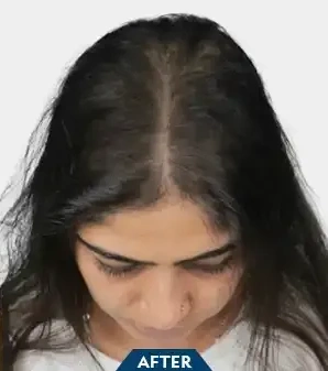 Androgenetic Alopecia - After Treatment