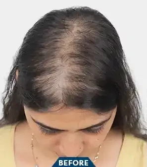 Androgenetic Alopecia - Before Treatment