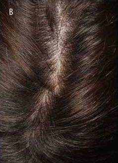 Seborrheic Dermatitis & Scalp Scaling - After Treatment