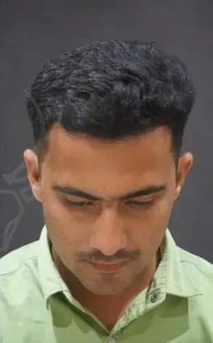 Micro-FUE Hairline Restoration - After Treatment