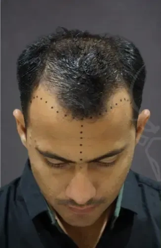 Micro-FUE Hairline Restoration - Before Treatment