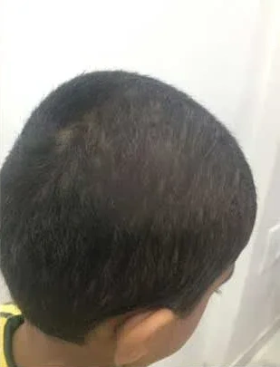 Alopecia Areata - After Treatment