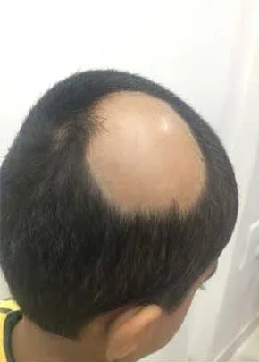 Alopecia Areata - Before Treatment