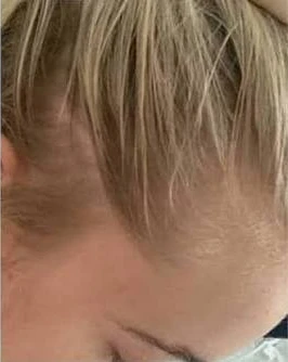 Female Diffuse Telogen Effluvium - After Treatment