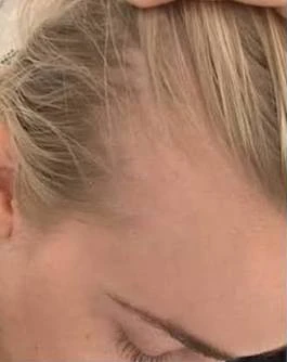 Female Diffuse Telogen Effluvium - Before Treatment