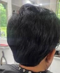 Medical Cranial Prosthesis Custom Fit - After Treatment