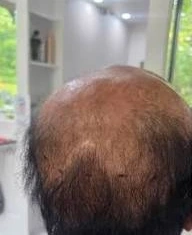 Medical Cranial Prosthesis Custom Fit - Before Treatment