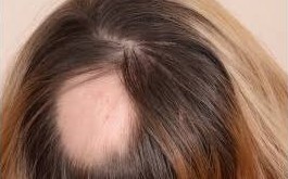 Hair Camouflage