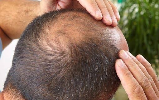 Hair Fall Treatment