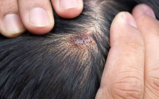 Hair & Scalp Diseases