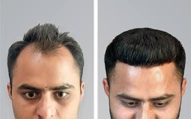 Hair Transplant