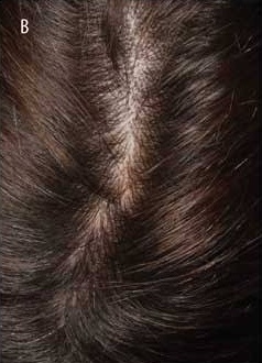 Patient scalp completely cleared of dermatitis and flakes after 6 weeks